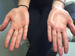 hyperhidrosis-sweaty-hands